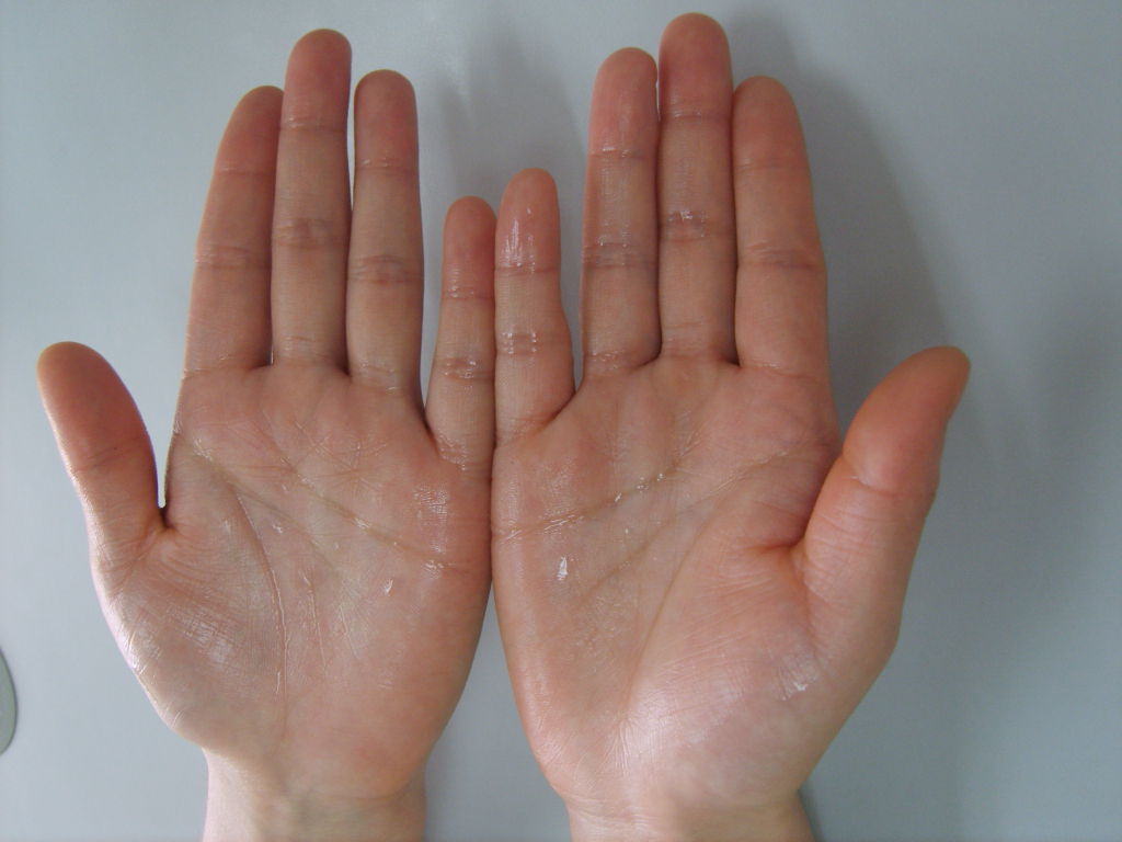 了解多汗症_手汗症_疾病介绍_介绍 - 好大夫在线