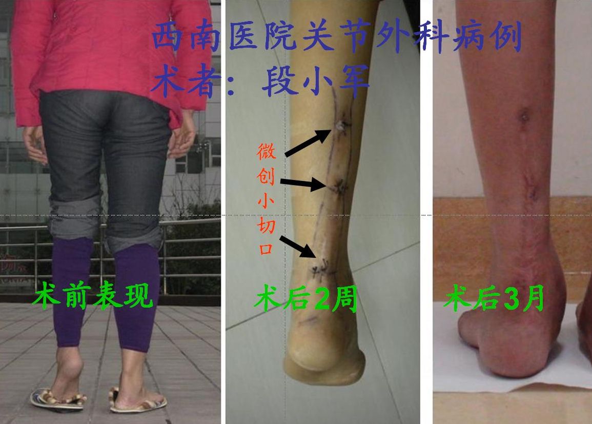 採用微創技術治療嚴重跟腱攣縮