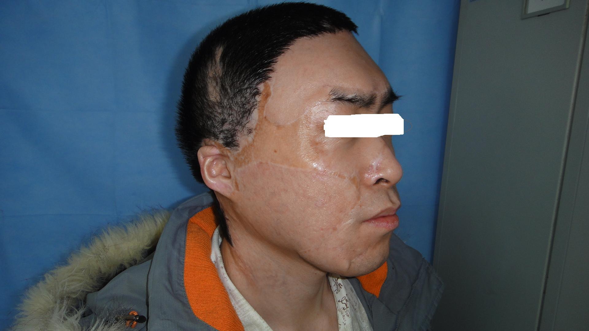 脸部植皮手术后恢复图图片