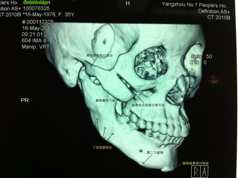 下颌角手术ct图片