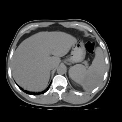 脾梗死_脾切除手术_脾切除手术检查 - 好大夫在线