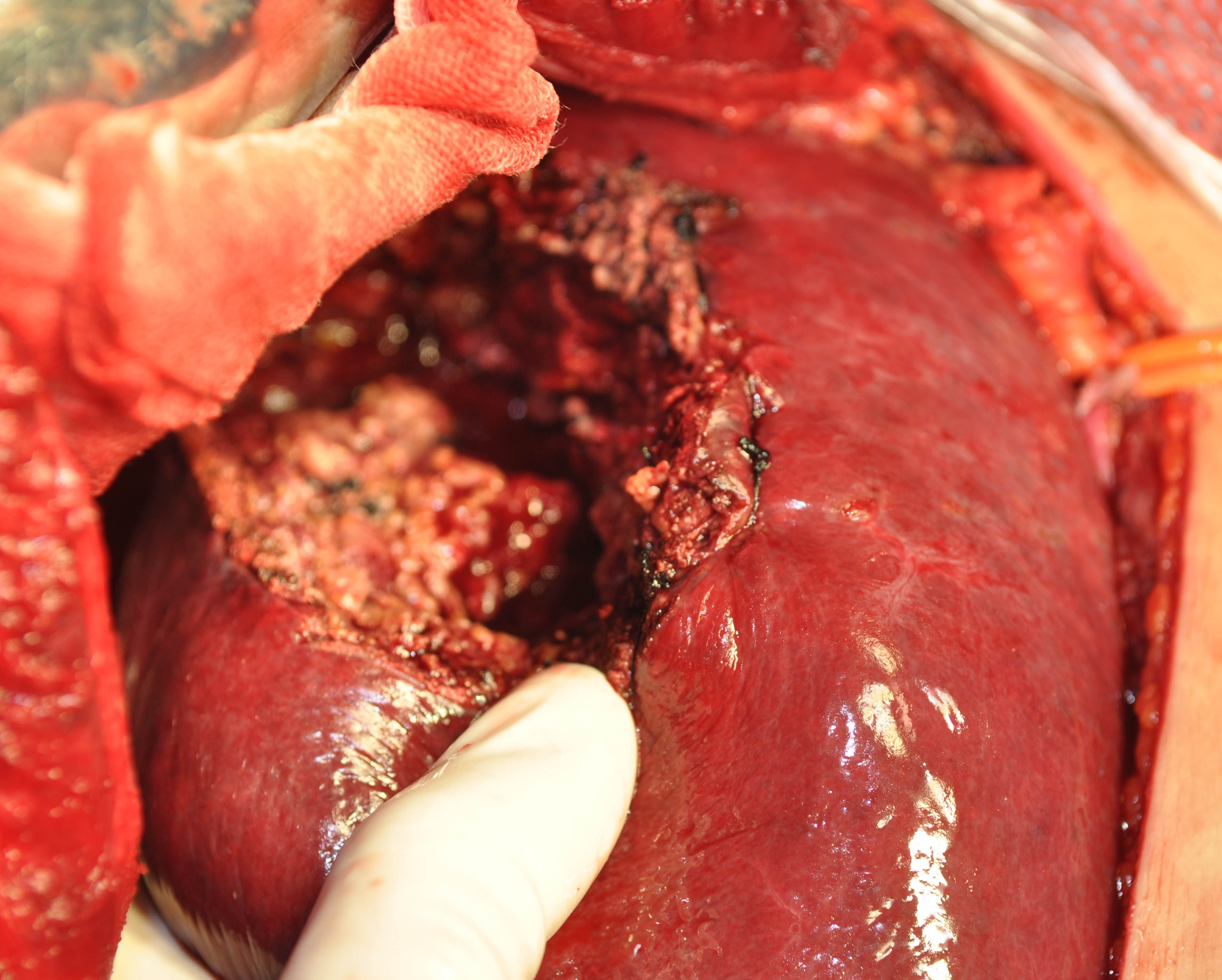 肝中叶局灶性增生结节易误诊为肝癌 
