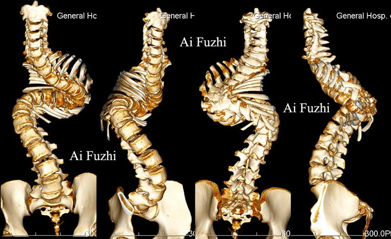 先天性脊柱側凸典型病例二