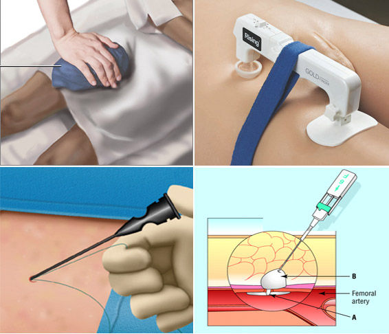 冠状动脉造影术后是否必须使用止血器或血管缝合器?