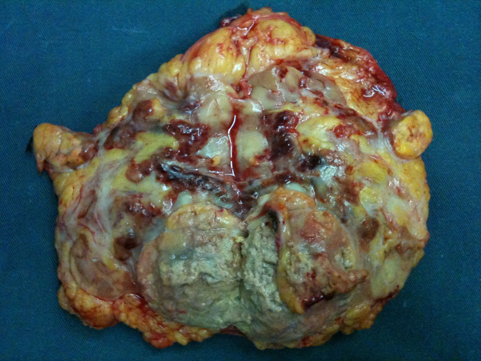 晚期转移性肾癌采用索坦新辅助治疗后肿瘤和癌栓缩小,手术切除 - 好