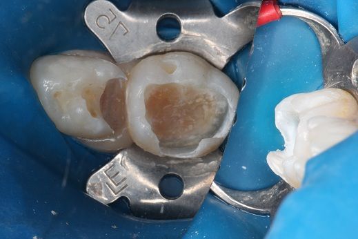 橡皮障技术----给儿童看牙带来安全和舒适 - 好大夫在线