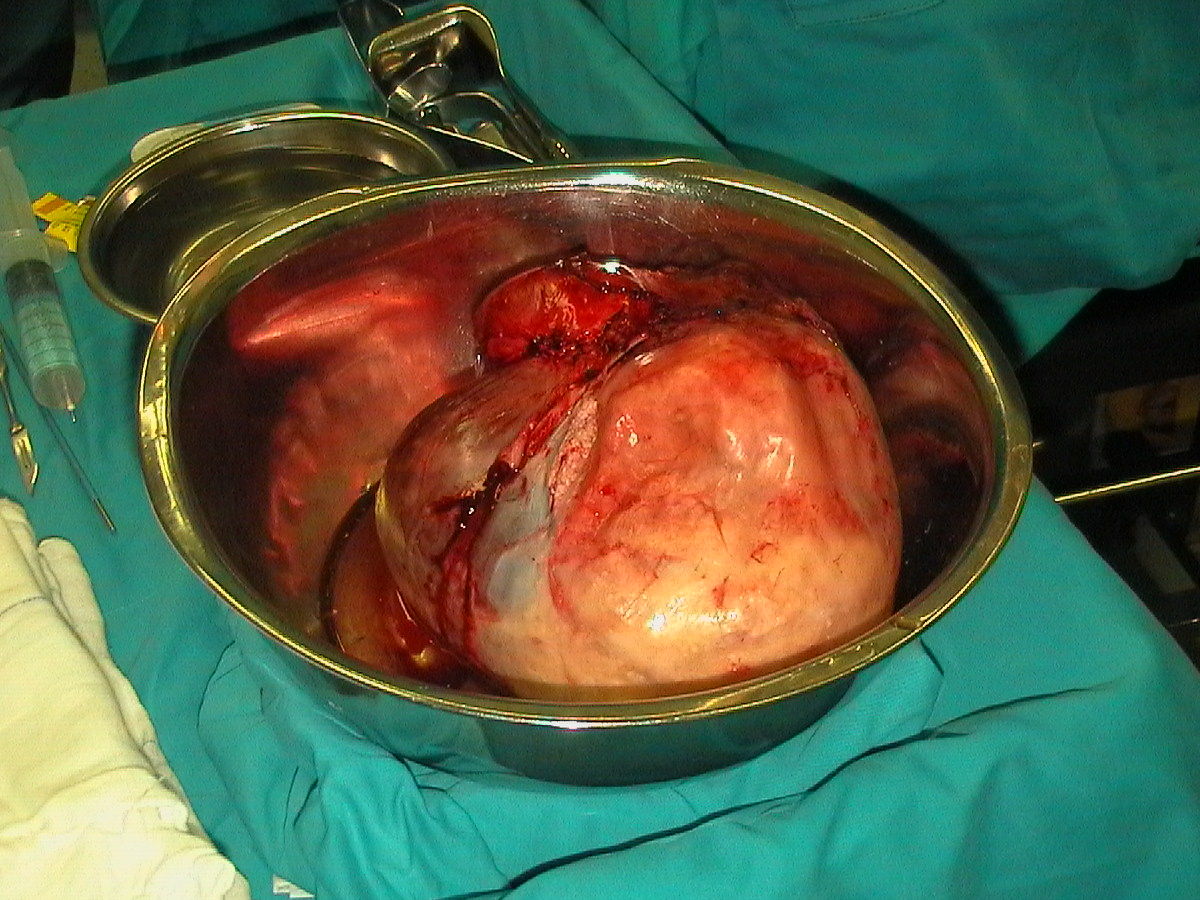 腹膜后巨大畸胎瘤