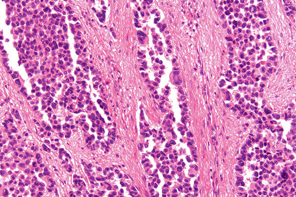 腺泡型横纹肌肉瘤组织病理学表现为松散排列的恶性细胞,呈类似肺泡