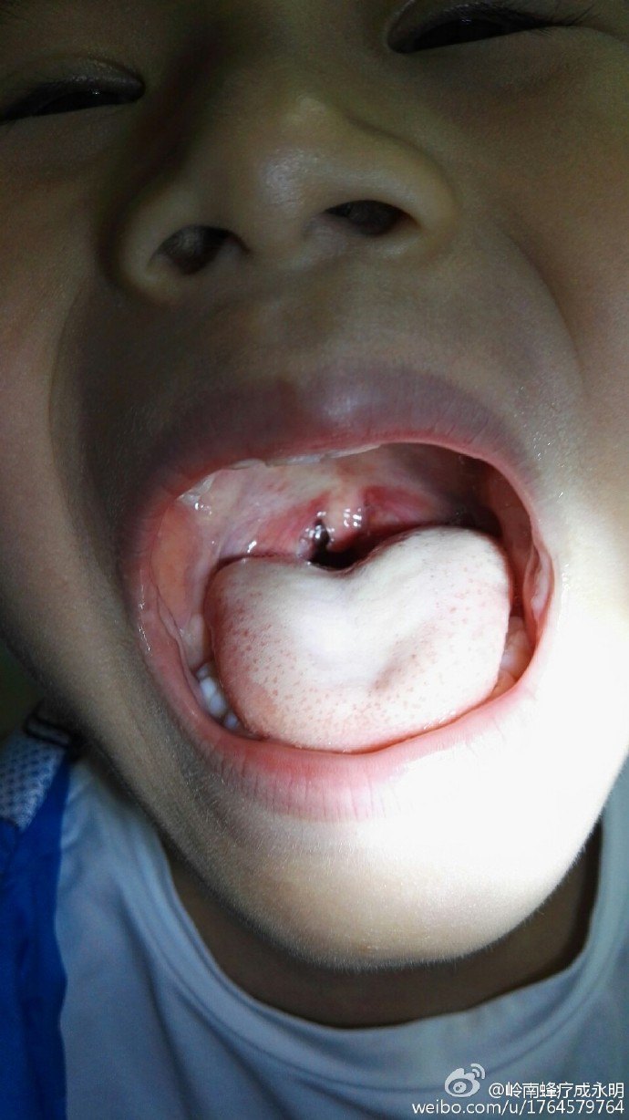 疱疹性咽峡炎的症状图图片
