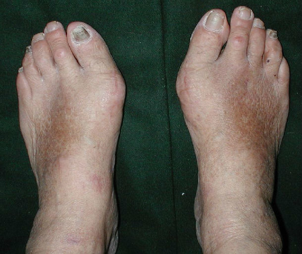 足趾残缺或畸形图片