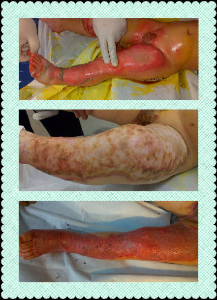 小儿大面积深度烧伤创面植皮 - 好大夫在线