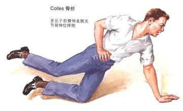 老年人摔倒时手下意识的撑地后,很容易出现手腕骨折.