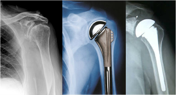 人工关节置换术(治疗严重关节疾病的有效方法)