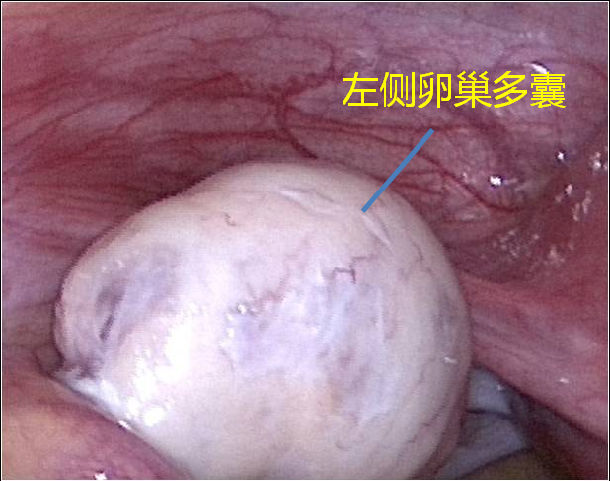 多囊卵巢综合症:微创助孕手术,把坚硬的卵巢推
