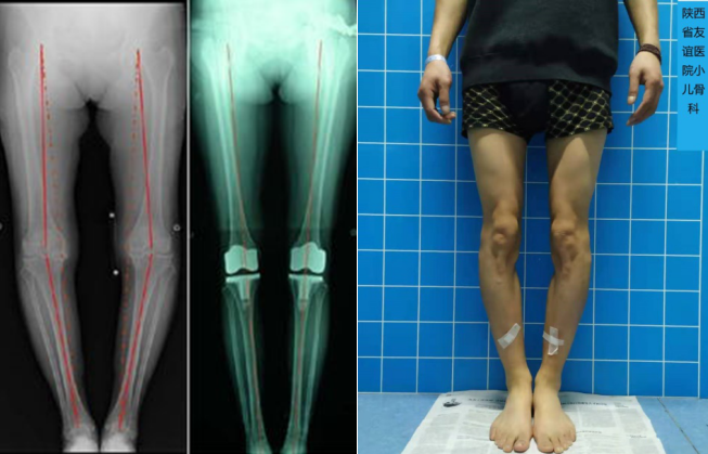 膝内翻畸形与膝外翻畸形的诊断与治疗