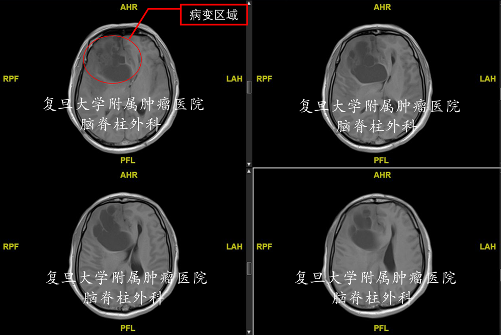 额叶占位切除术 颅骨成形术,术中冰冻提示:glioma,ii级及以上;肿瘤镜