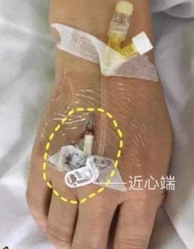 静脉留置针输液肝素与生理盐水封管的利弊