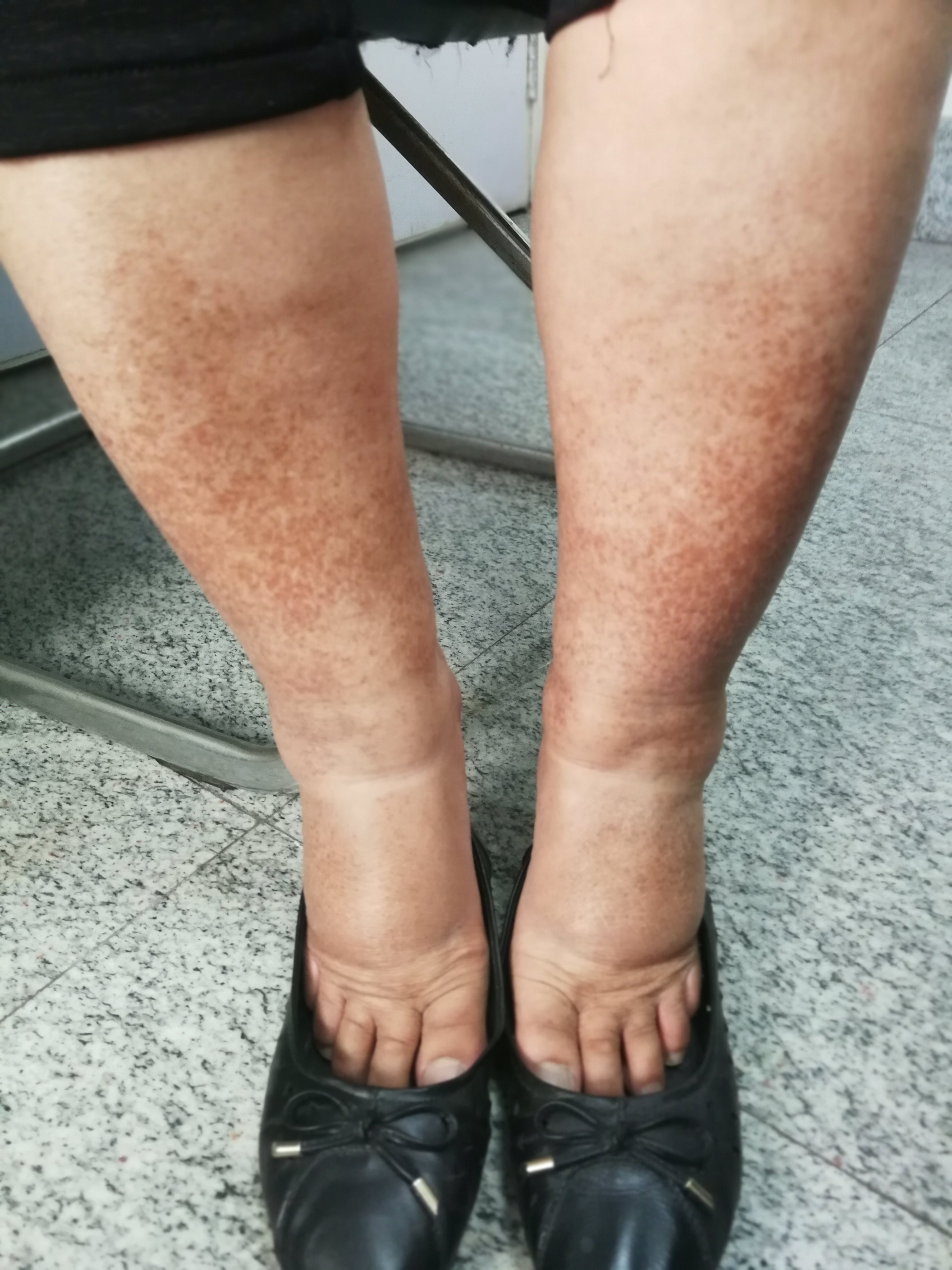 久坐也会导致腿肿 - 好大夫在线