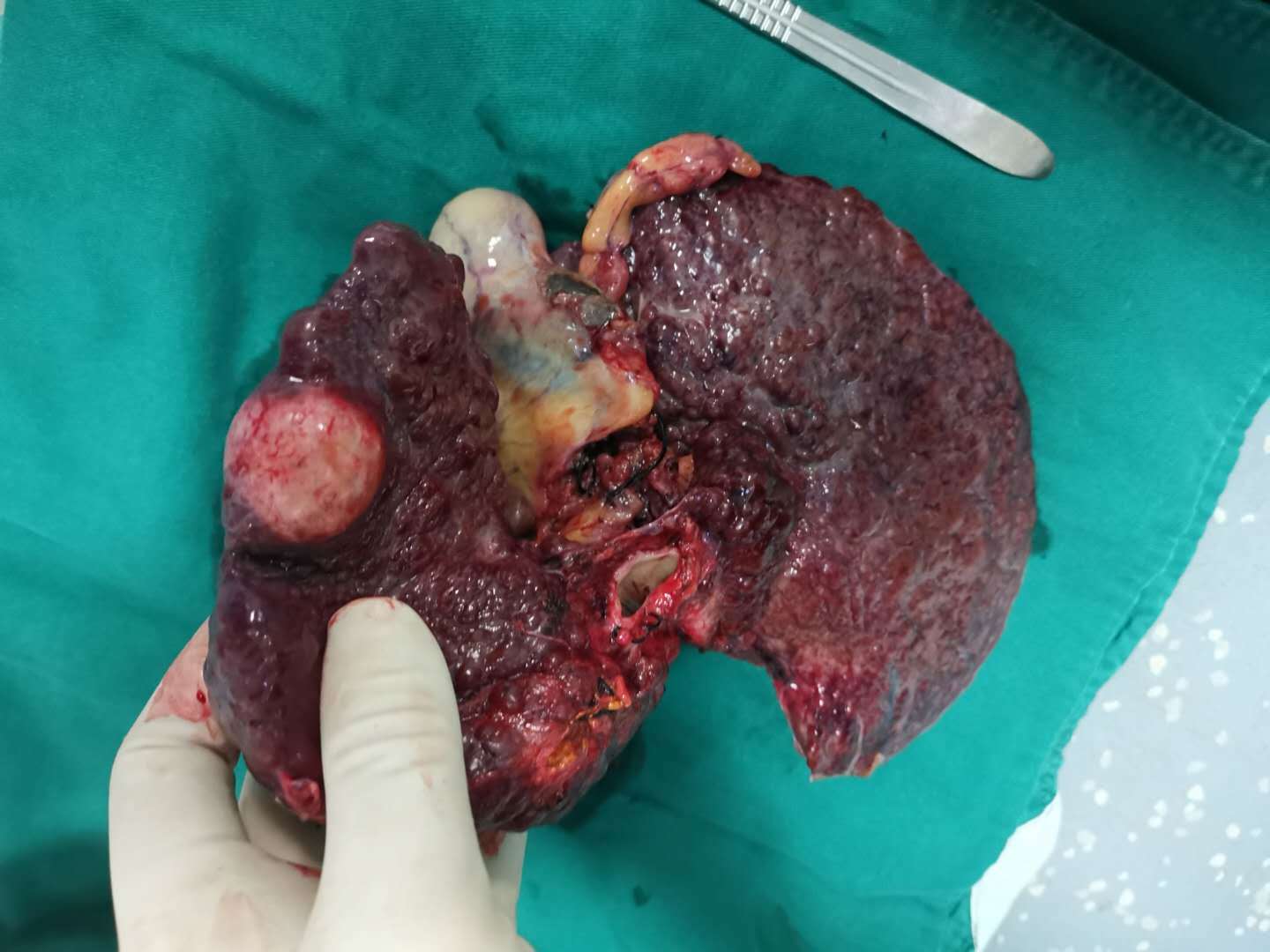 长了小肝癌哪种治疗方法最好