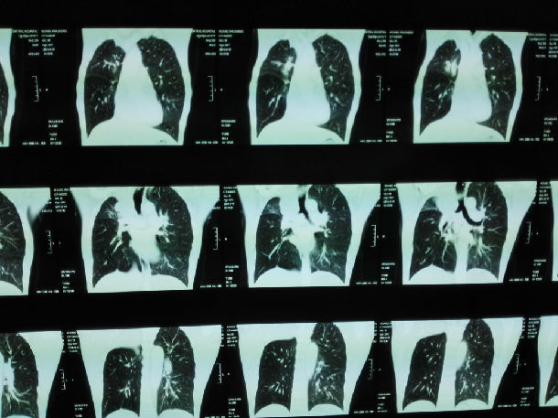 介入化疗联合粒子治疗中央型肺癌一例分享
