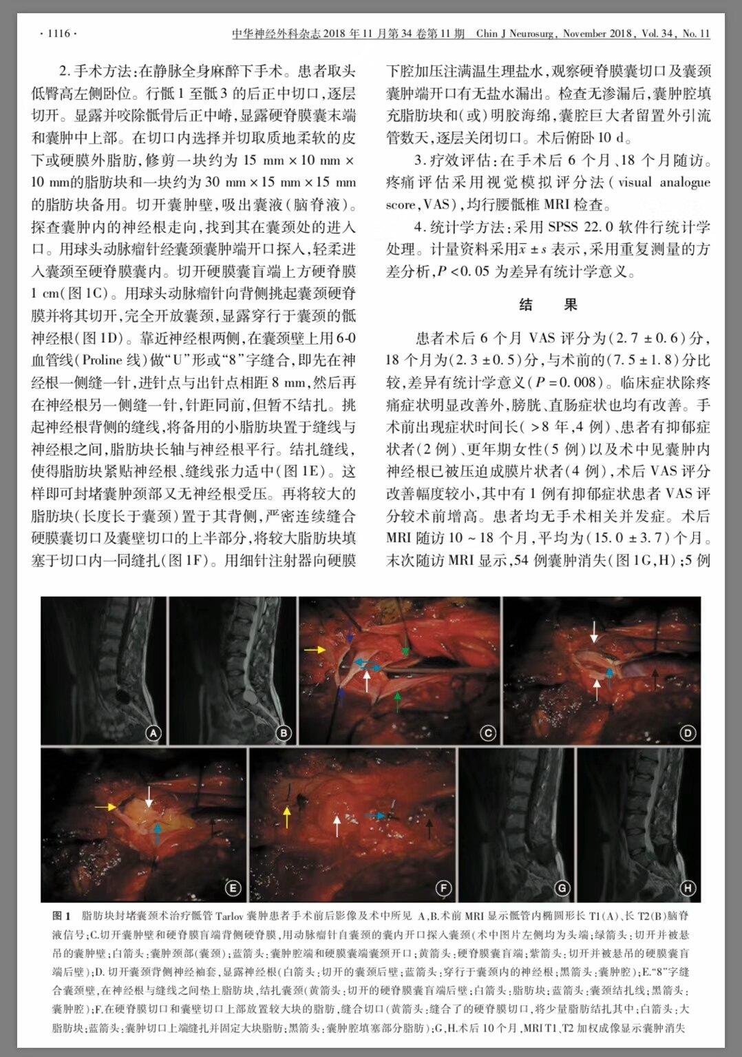 骶管囊腫治療研究及體會