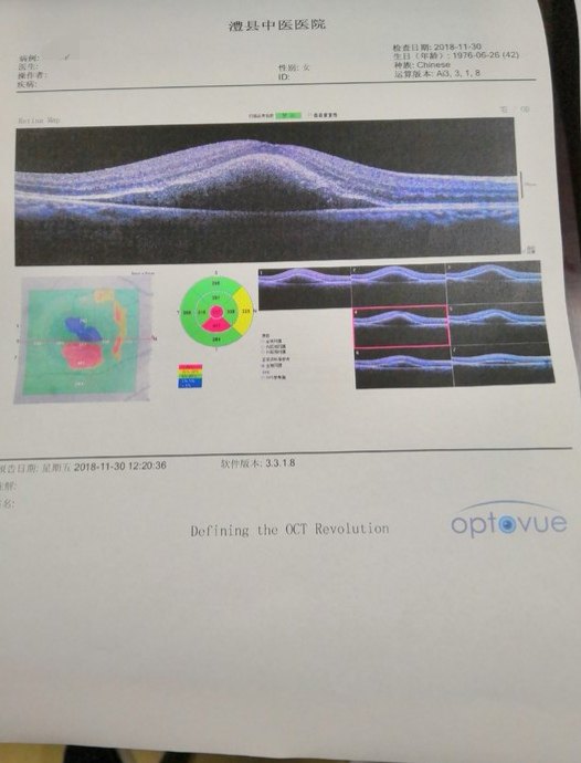 2018/11/30右眼黄斑oct.2018/11/30右眼黄斑oct.