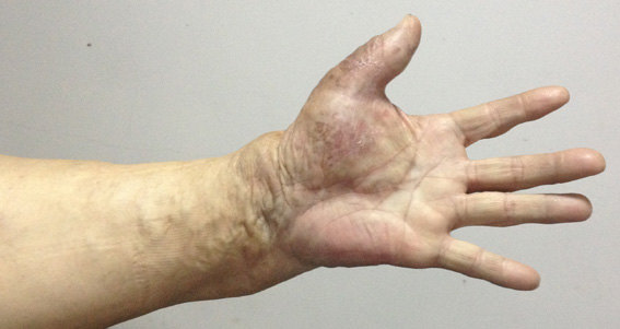 静脉曲张不简单