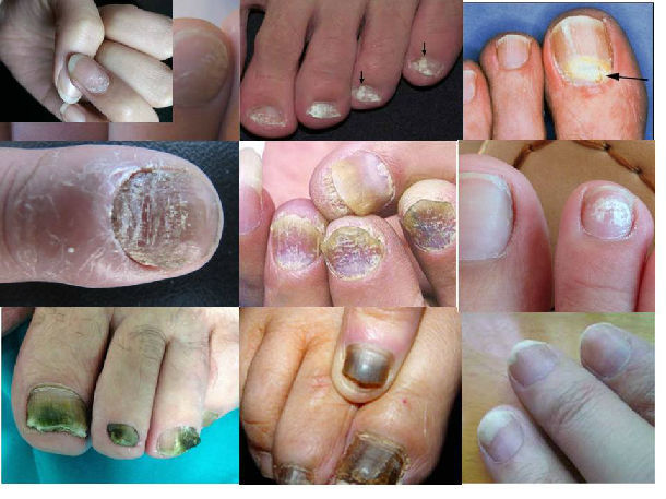灰指甲怎么治疗早期图片
