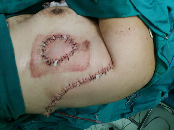 心脏手术后胸部慢性窦道,并感染 - 好大夫在线