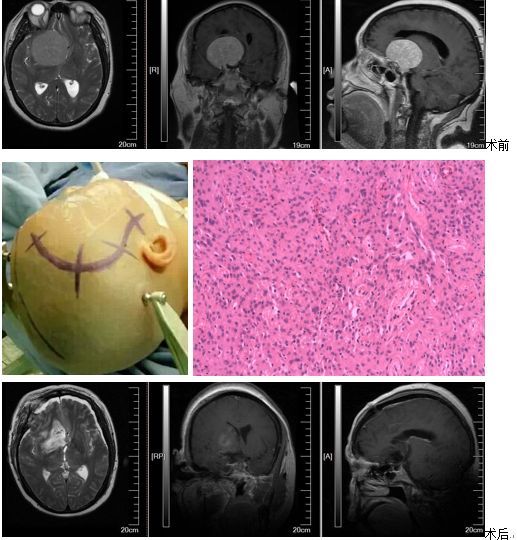 患者3-李某 鞍結節腦膜瘤 右額顳入路腫瘤切除術患者中年男性,既往體