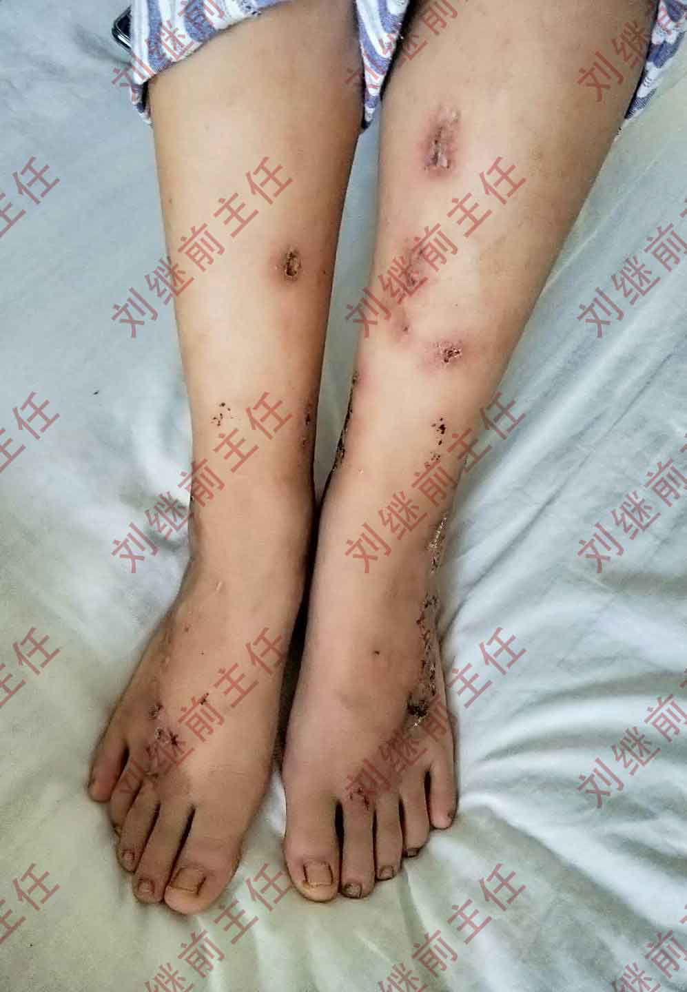 中医妙手挽救瓜藤缠花季少女双腿 - 好大夫在线