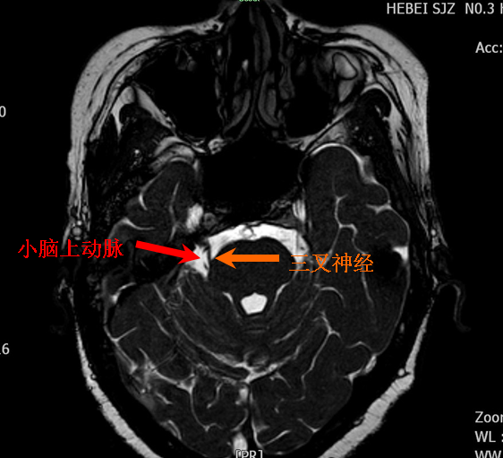 三叉神经磁共振图像图片