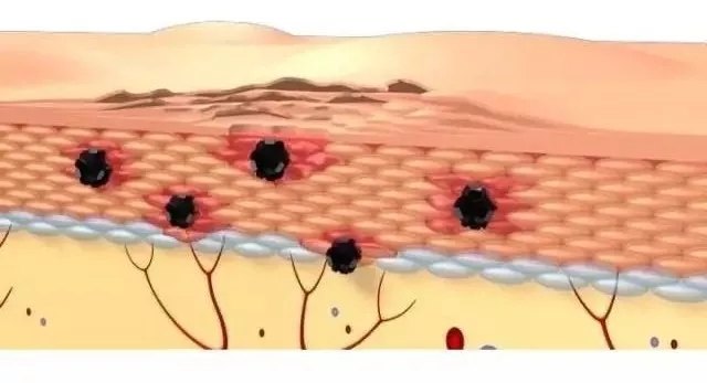 皮肤屏障受损后如何修复? - 好大夫在线