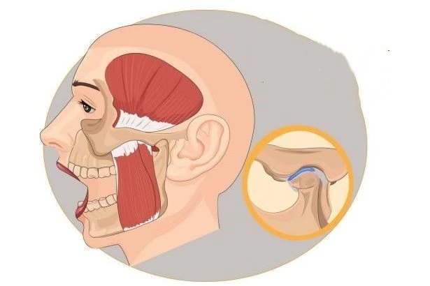 颞下颌关节紊乱