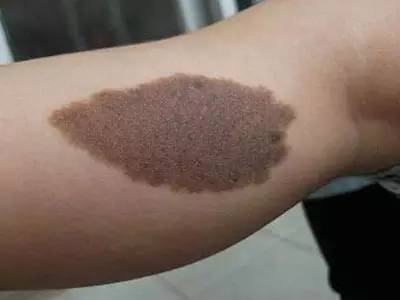 先天性色痣的外科治疗经验分享 - 好大夫在线