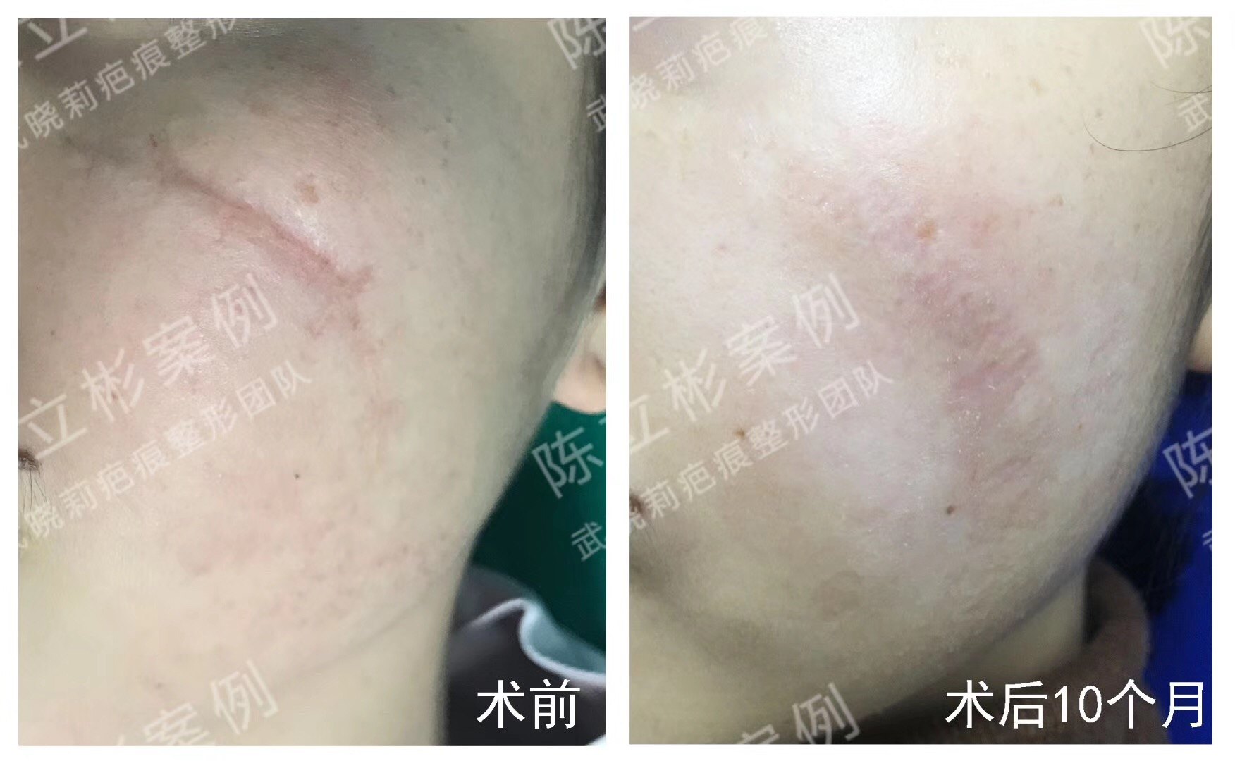 面部陈旧凹陷疤痕术后10月复诊 - 好大夫在线