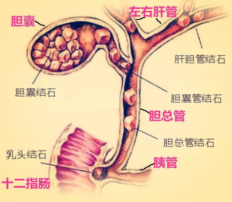 包括胆囊结石,胆总管结石,肝总管结石,肝内胆管结石,复合部位结石等