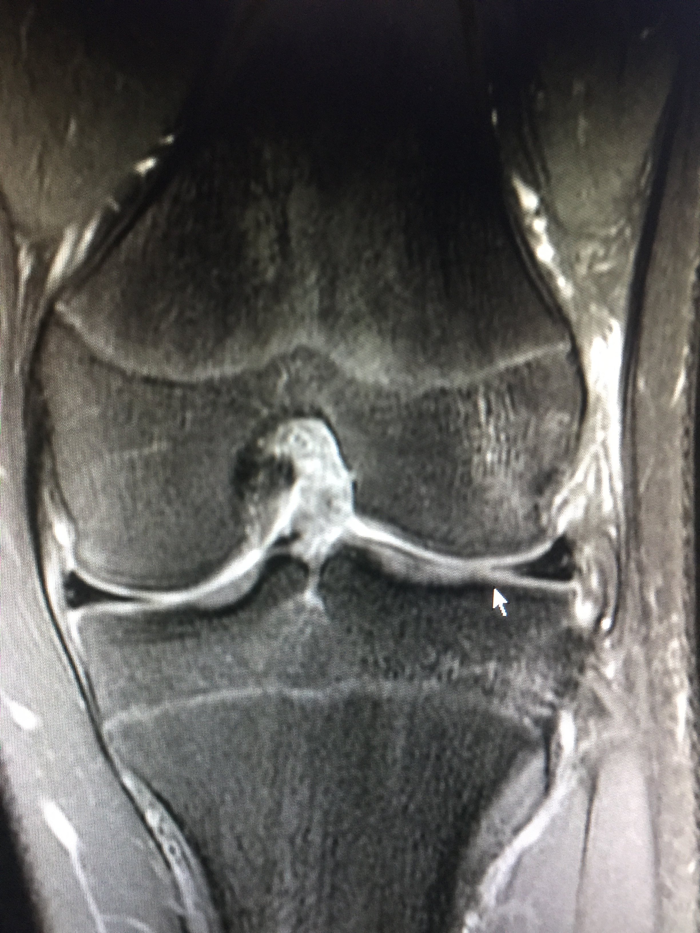 膝关节核磁前交叉韧带图片
