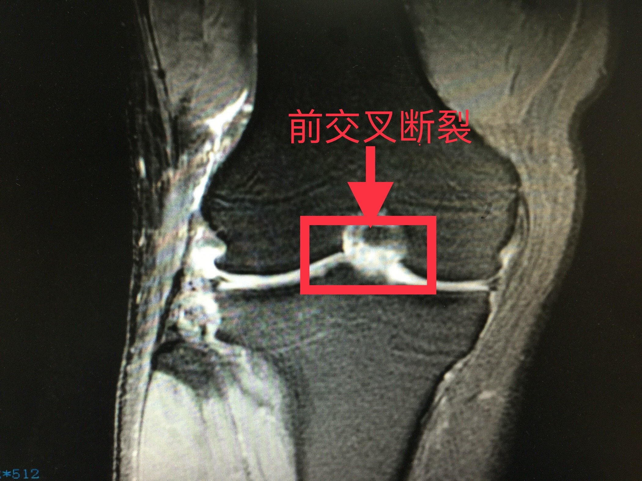 膝关节前交叉断裂治疗成功典型案例 