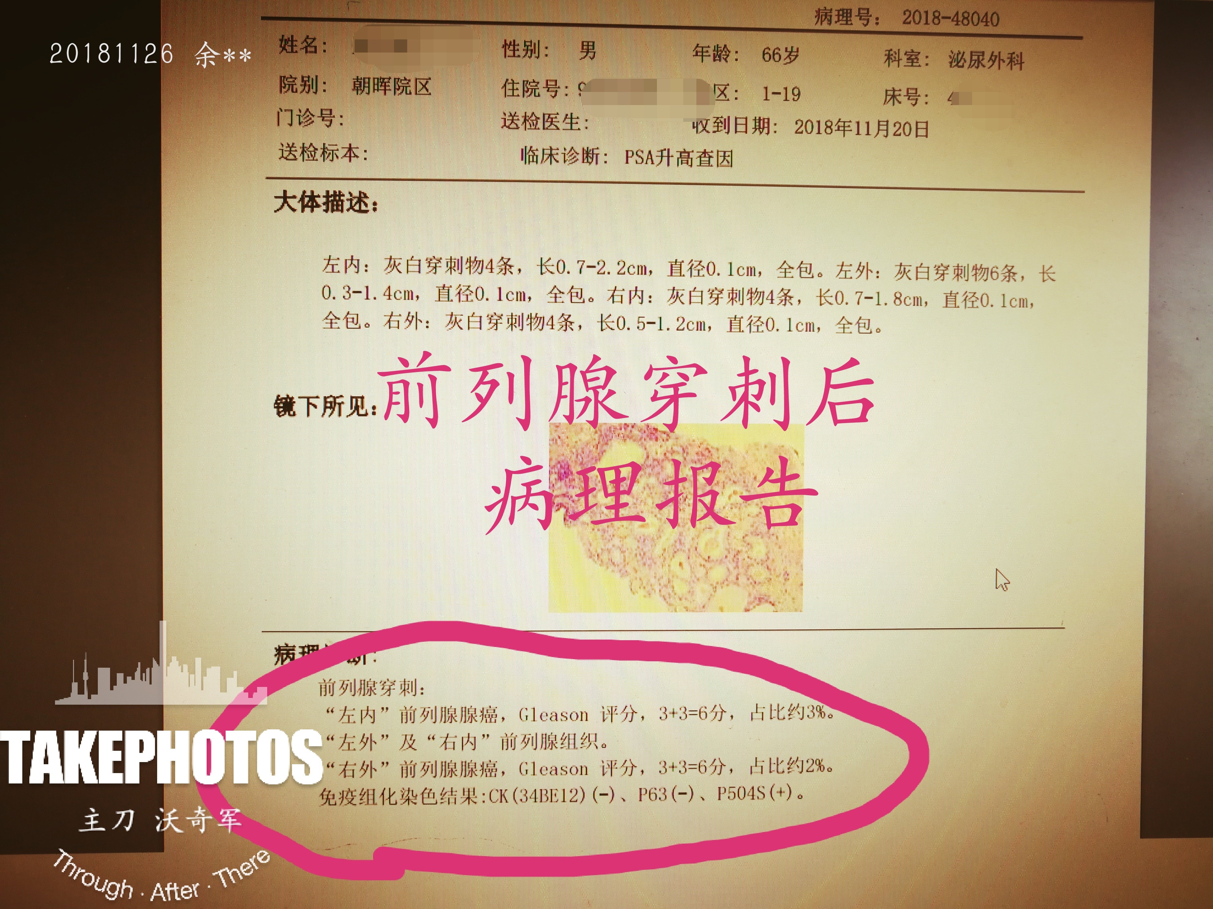 前列腺癌_前列腺癌检查 - 好大夫在线