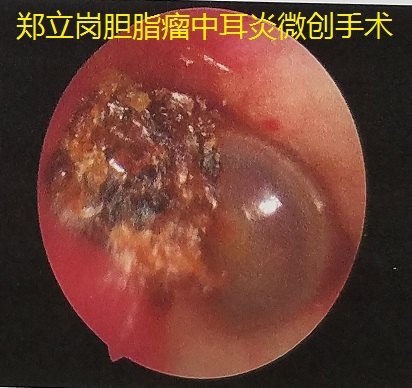 外耳道耳朵胆脂瘤图片图片