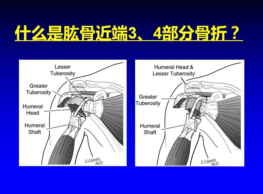 如何做好肩關節肱骨近端骨折人工肱骨頭置換手術(半肩置換)