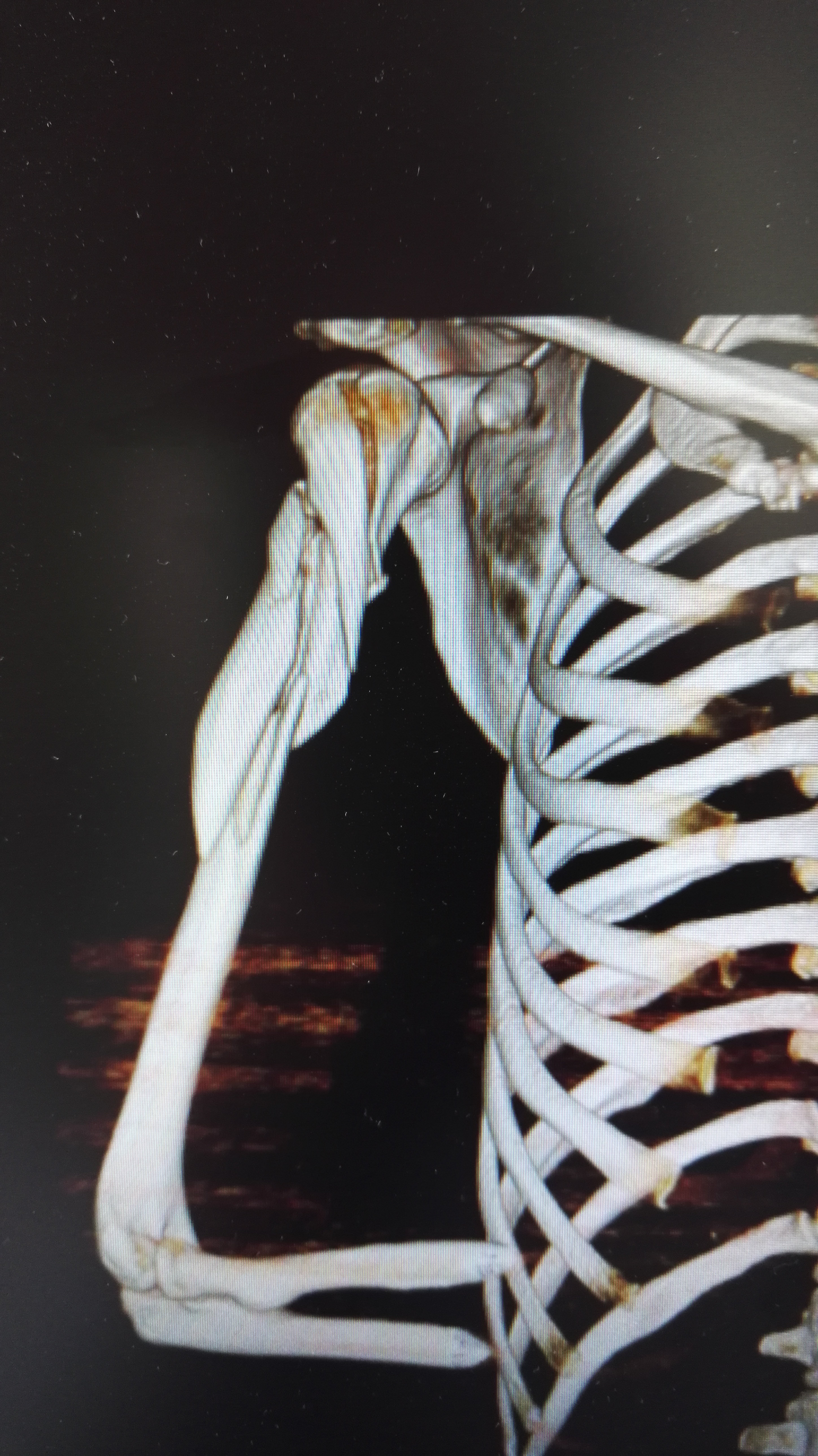 肱骨粉碎性骨折图片图片