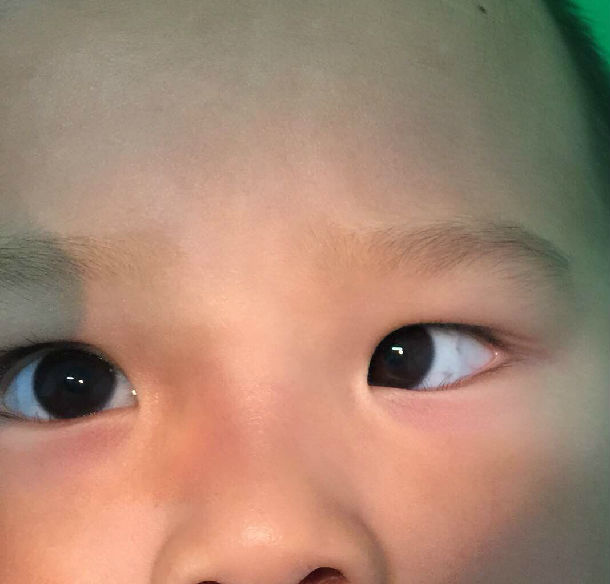 儿童斜视什么时候手术为最佳时机?