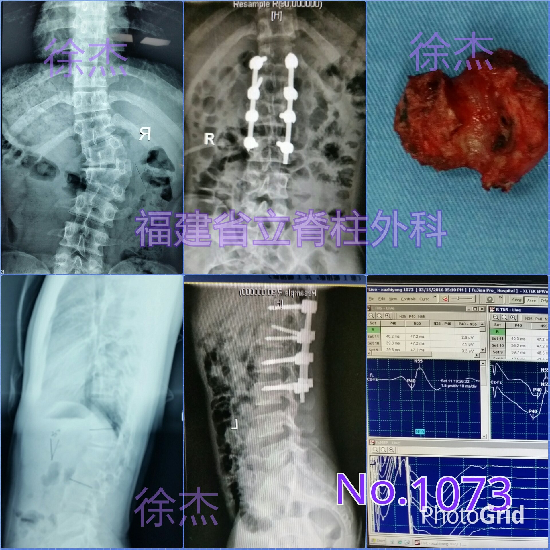 多長一個三角形椎體引起的脊柱側彎加駝背畸形的矯正