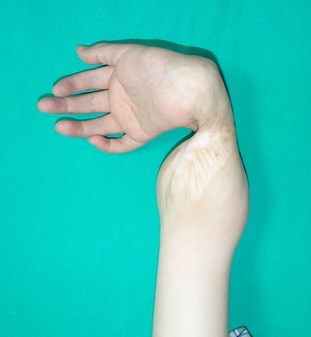 腕关节严重尺偏畸形(尺拐手)的矫正—典型病例