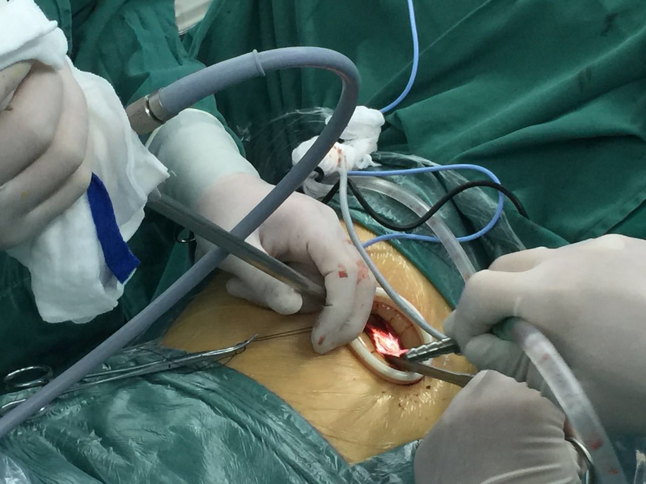 积极选择手术,治疗早期癌症_肺癌_手术_治疗方式 - 好大夫在线