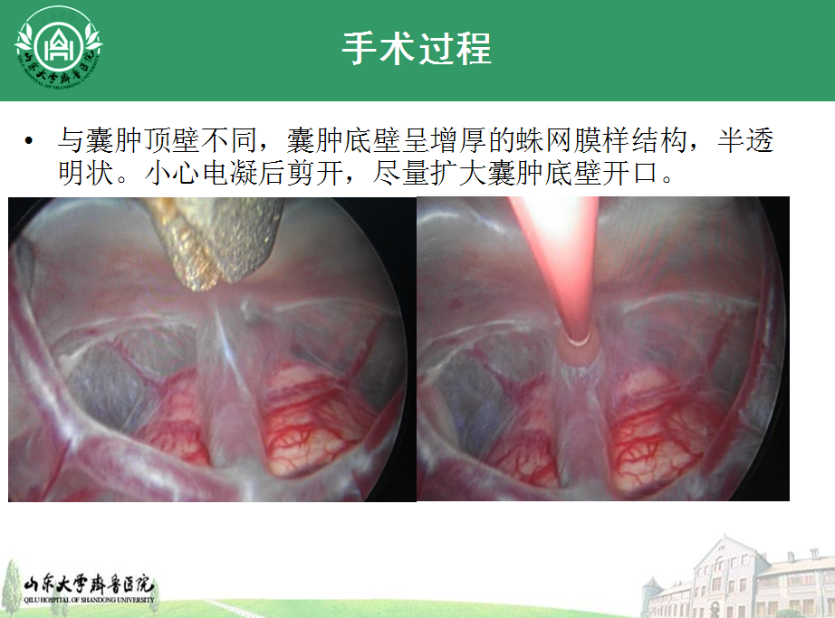 儿童鞍上池蛛网膜囊肿的神经内镜治疗