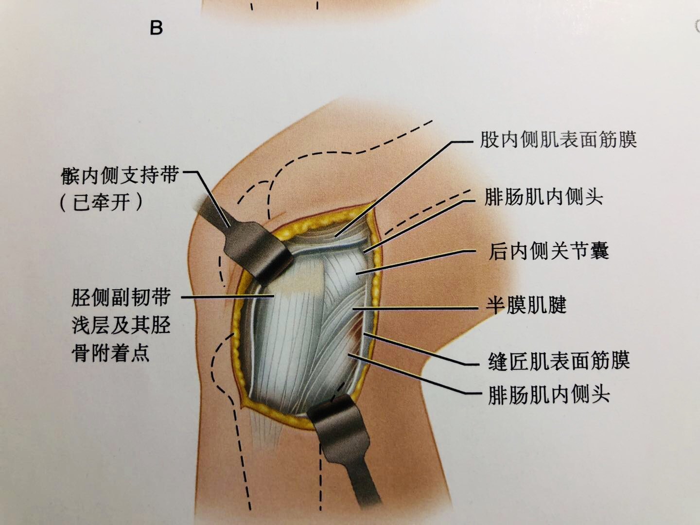 膝关节外侧副韧带解剖图片