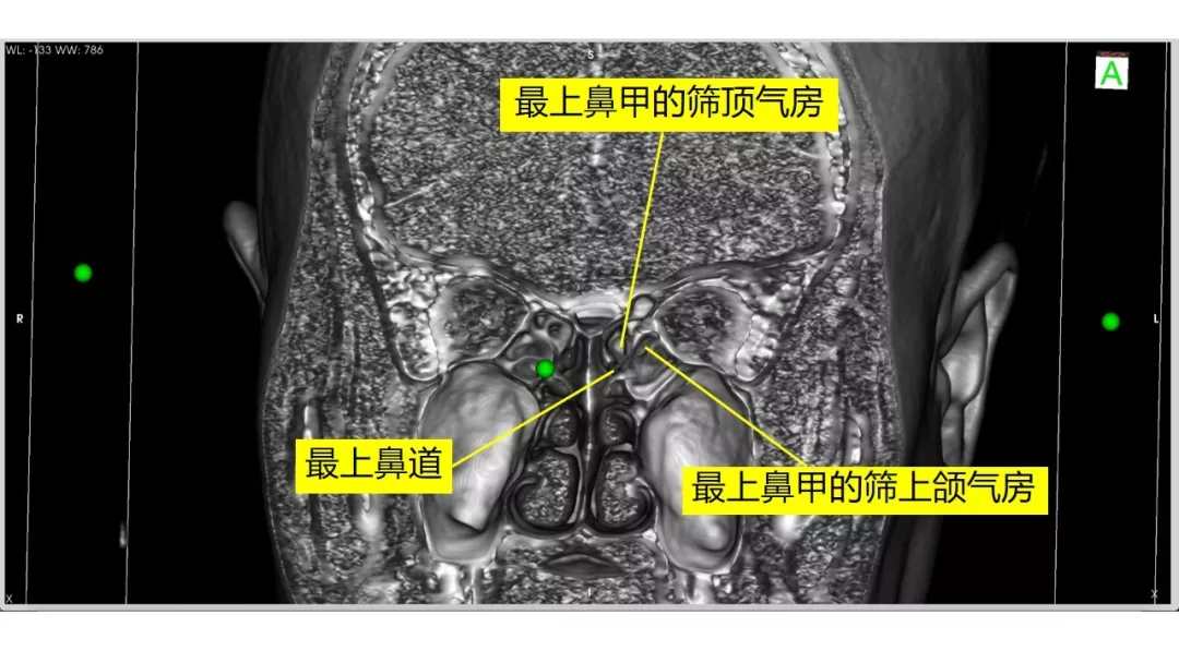 前床突磨除与脑积液漏处理